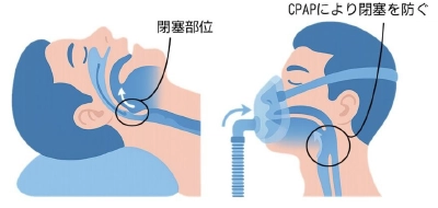 CPAP療法で使用する機器のイメージ