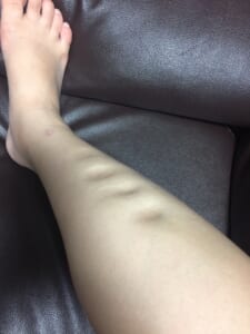 足のむくみの画像