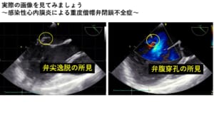 僧帽弁閉鎖不全症と感染性心内膜炎のイメージ