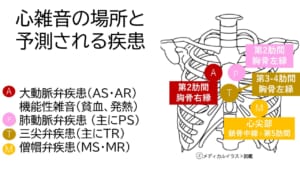 心雑音の場所と予測される疾患