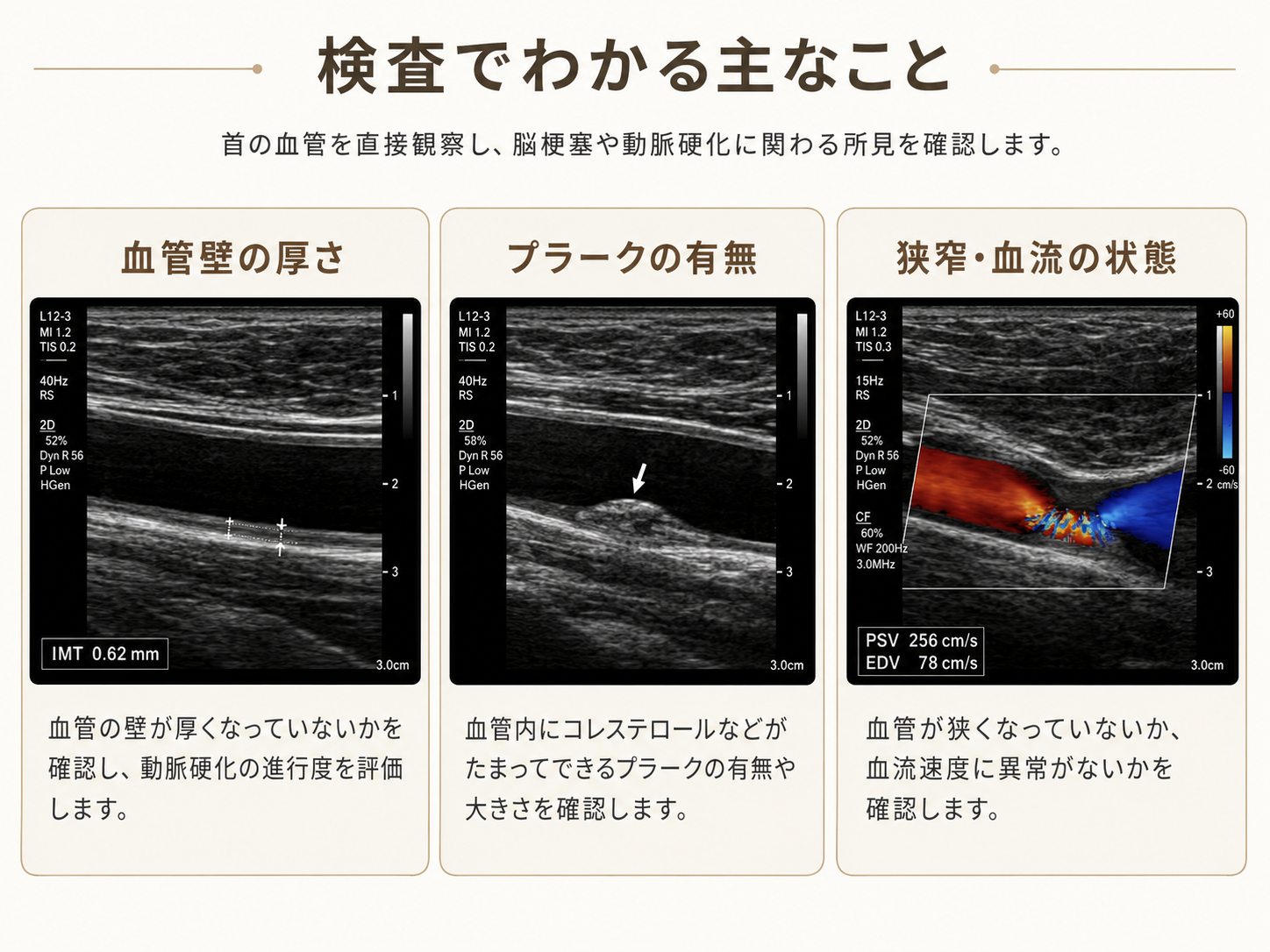 頚動脈エコーの所見。血管壁の厚さ、プラーク、狭窄と血流の状態を示す画像