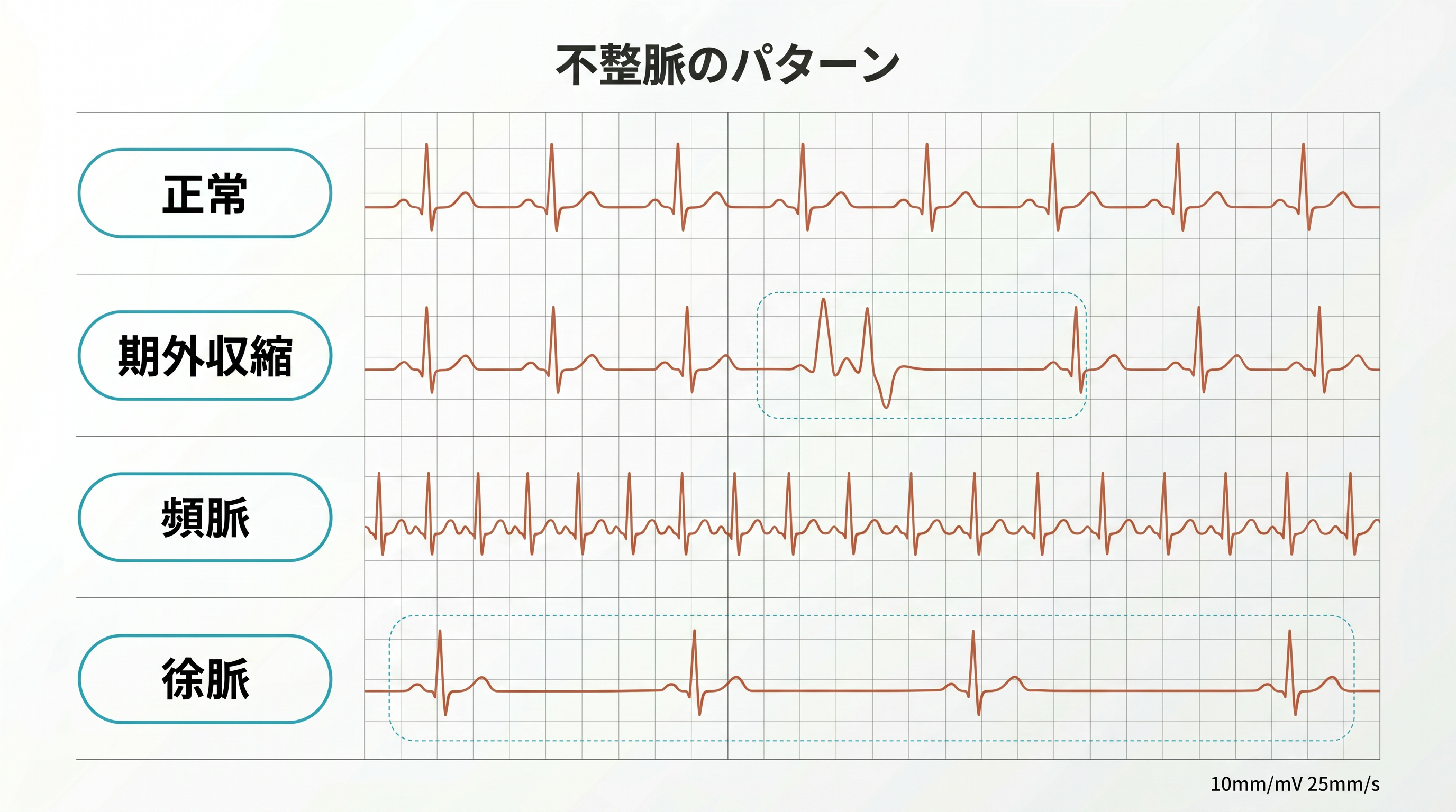 不整脈のパターンの例