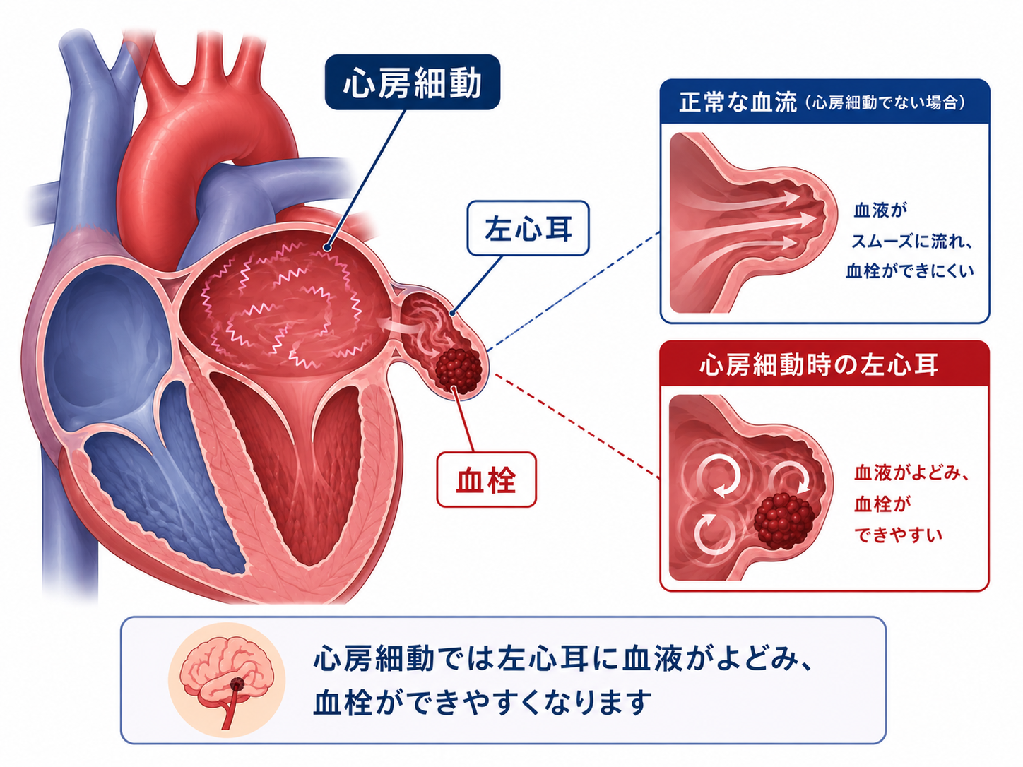 心房細動で血栓ができやすくなる仕組みを示す図