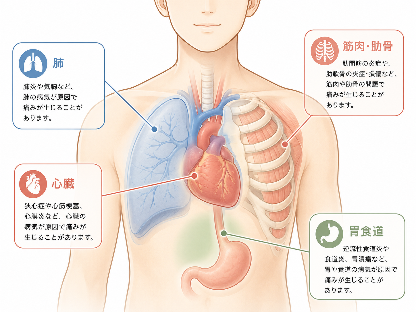 胸の痛みの原因として考えられる疾患を、心臓・肺・胃食道・筋肉や肋骨に分けて示した医療イラスト